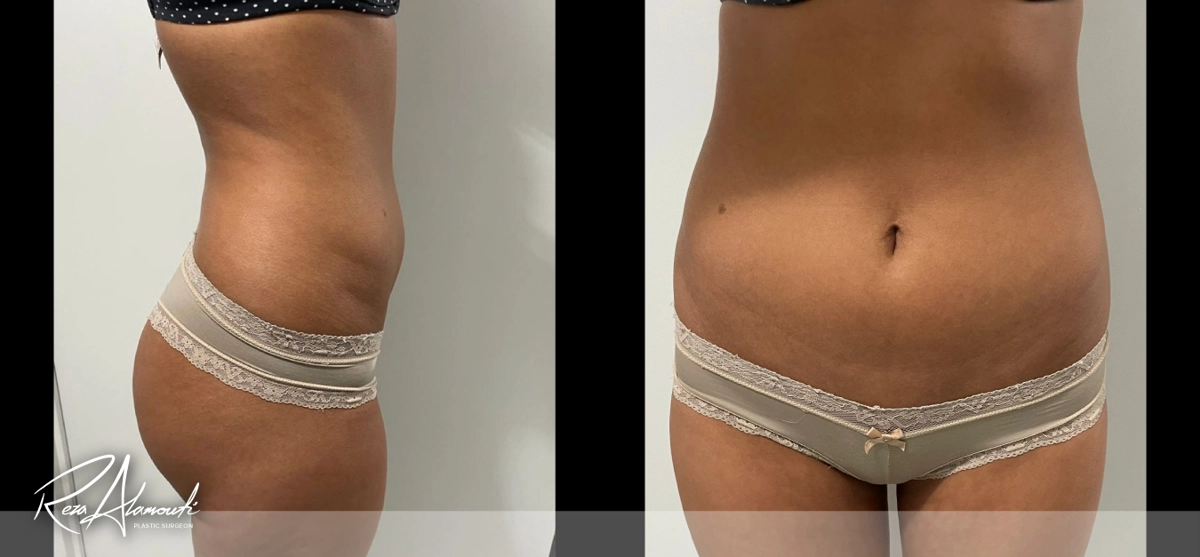 Interactive Before and After - Swipe to Reveal before image