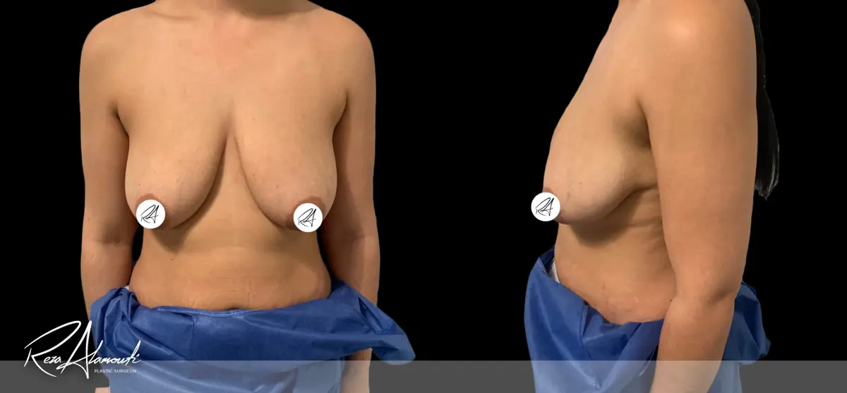 Interactive Before and After - Swipe to Reveal before image